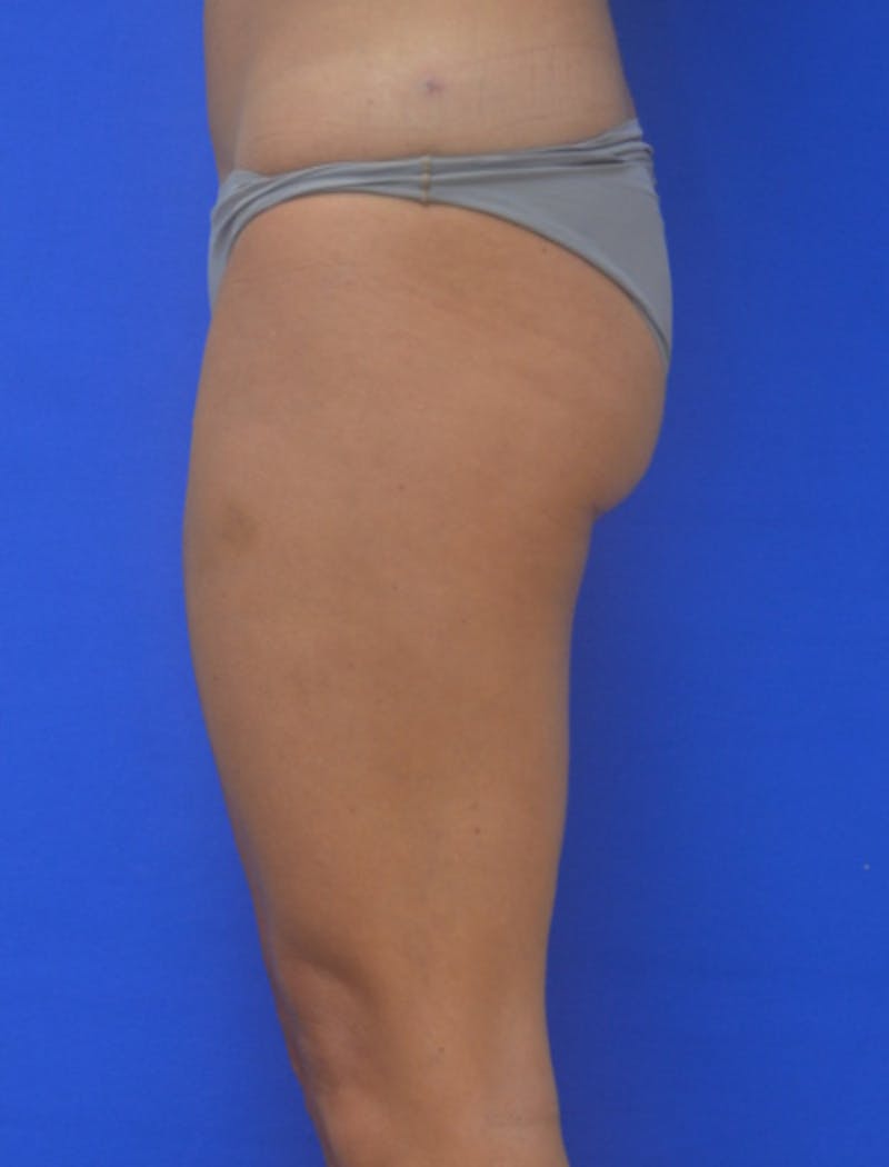 Liposuction Before & After Gallery - Patient 722410 - Image 6