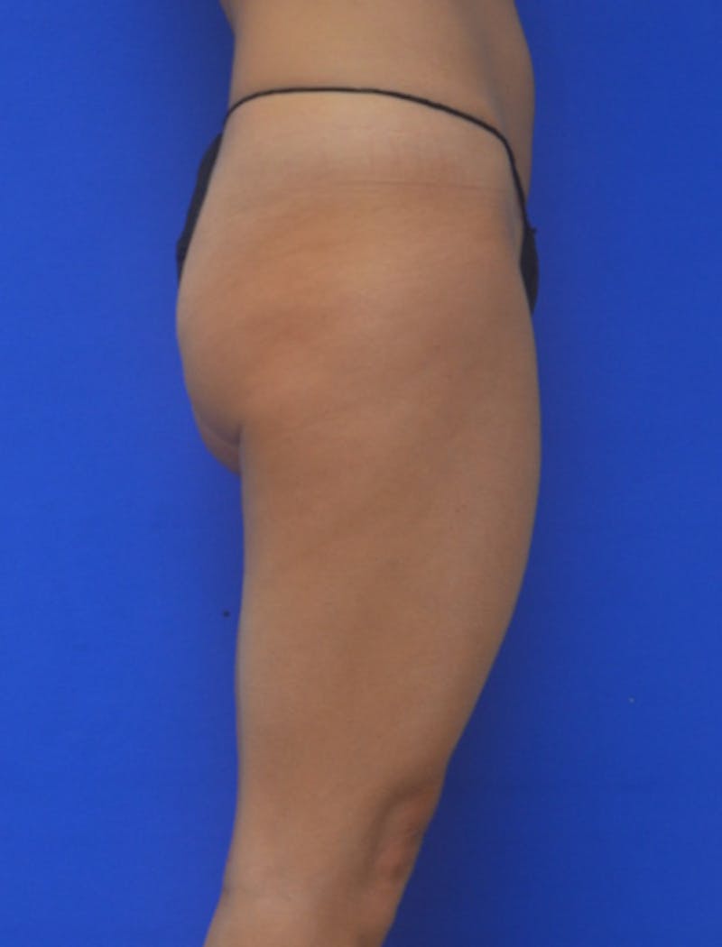 Liposuction Before & After Gallery - Patient 722410 - Image 7