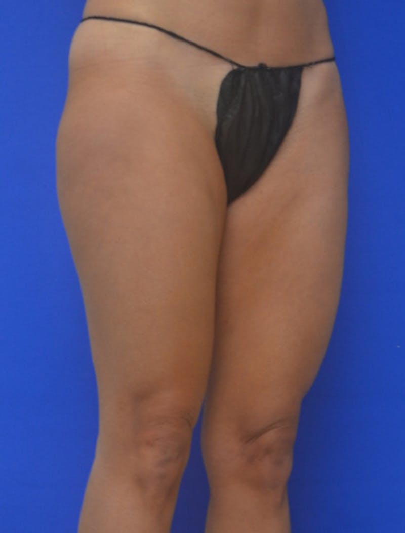 Liposuction Before & After Gallery - Patient 722410 - Image 9