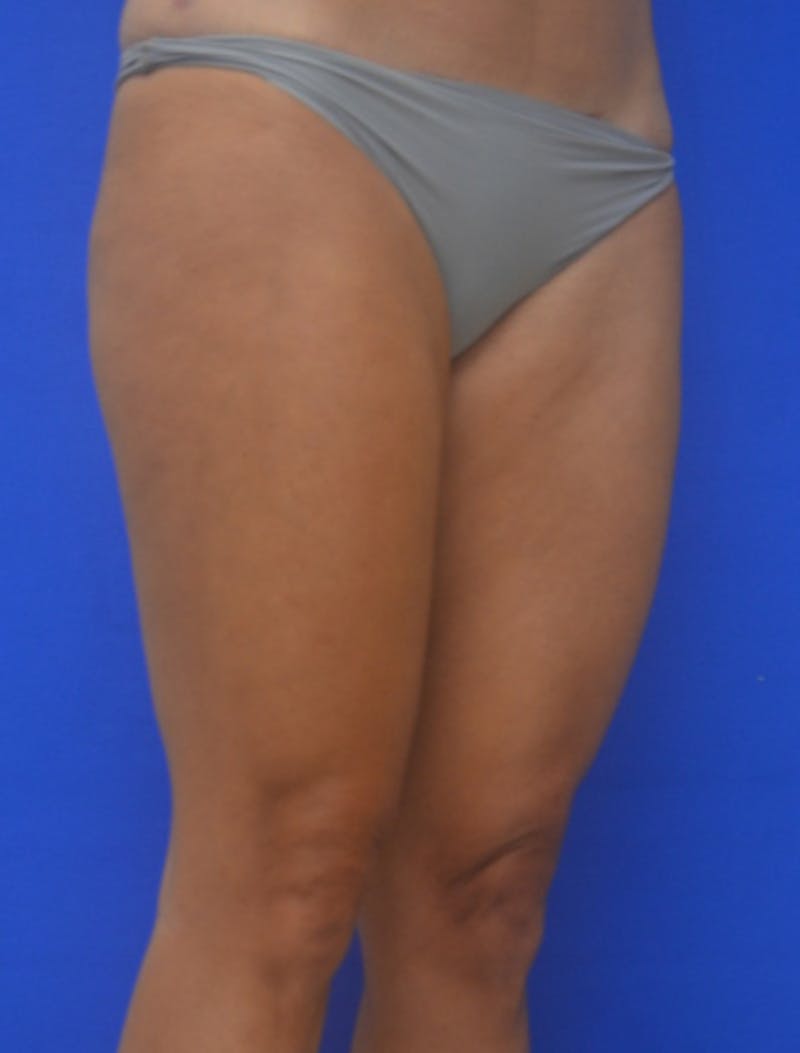 Liposuction Before & After Gallery - Patient 722410 - Image 10
