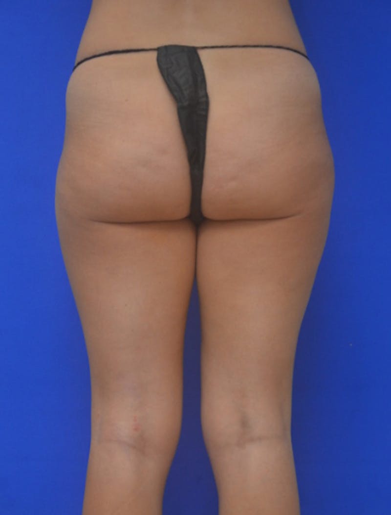 Liposuction Before & After Gallery - Patient 722410 - Image 11