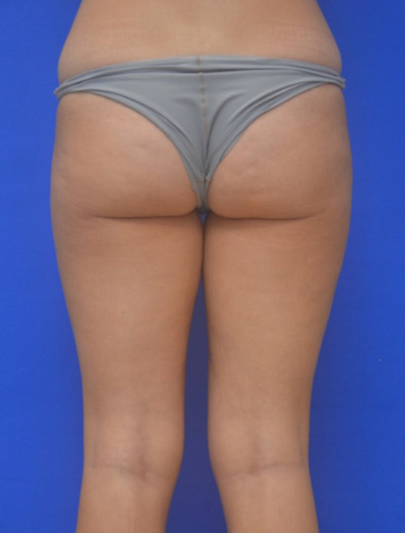 Liposuction Before & After Gallery - Patient 722410 - Image 12