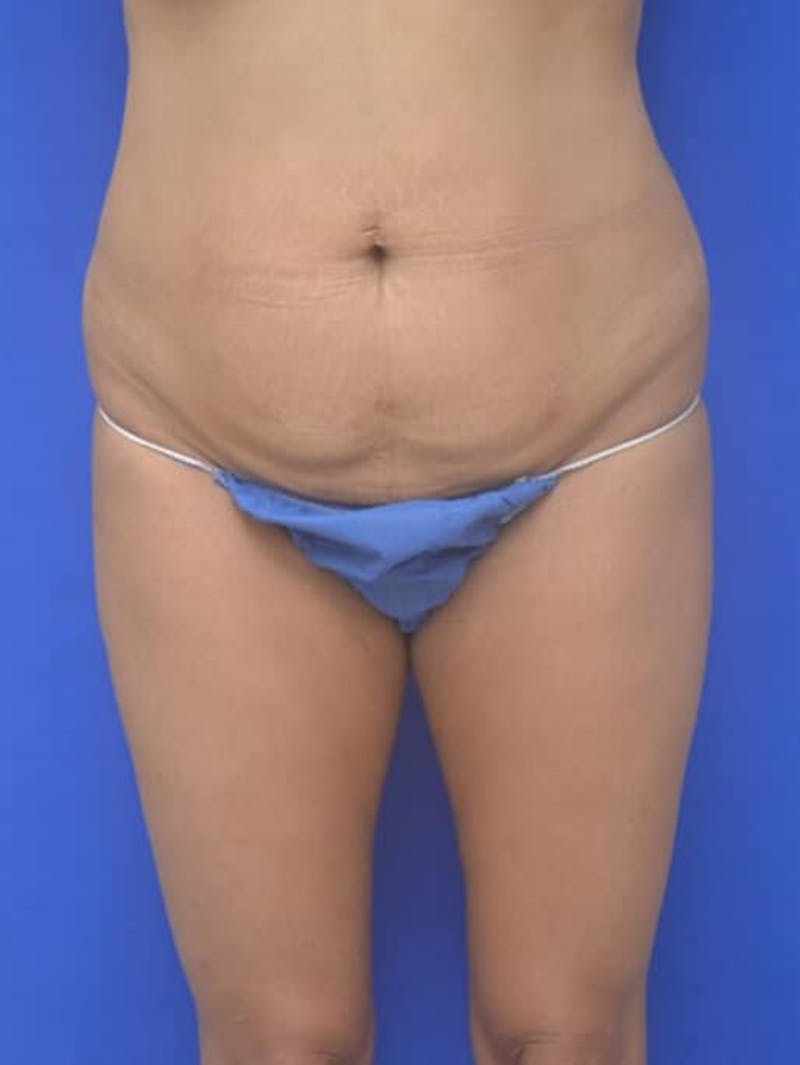 Liposuction Before & After Gallery - Patient 628941 - Image 1