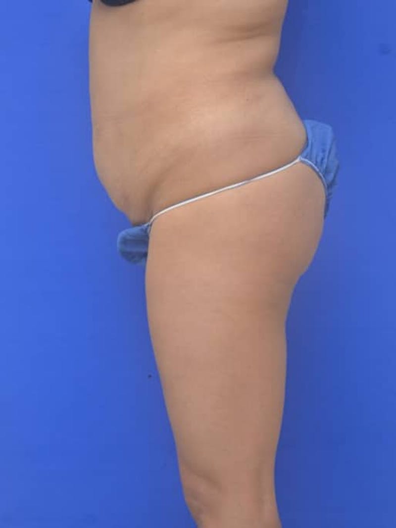 Liposuction Before & After Gallery - Patient 628941 - Image 5