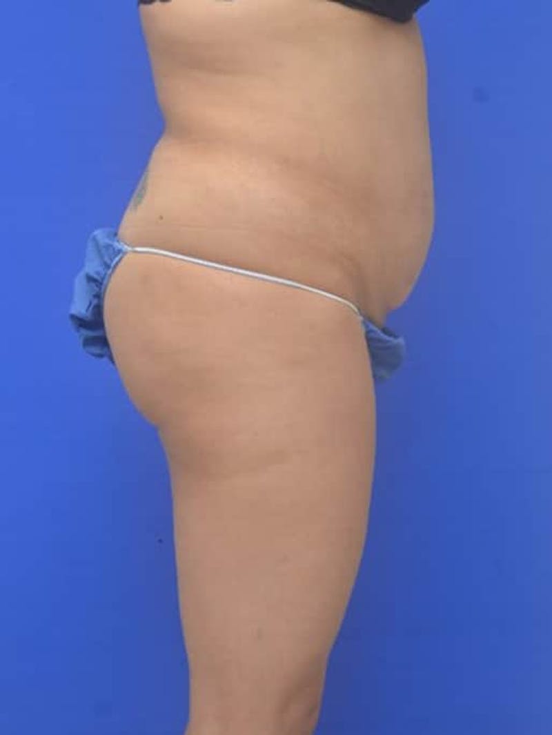 Liposuction Before & After Gallery - Patient 628941 - Image 7