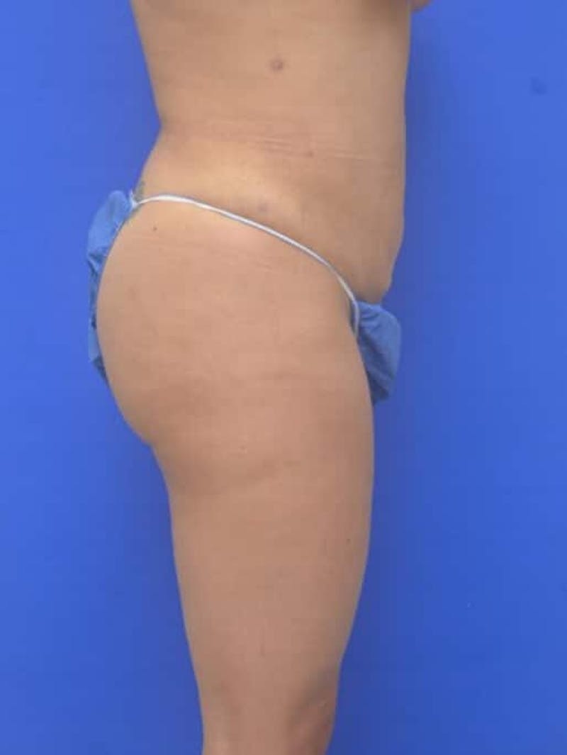 Liposuction Before & After Gallery - Patient 628941 - Image 8