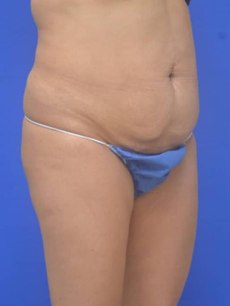Liposuction Before & After Gallery - Patient 628941 - Image 9