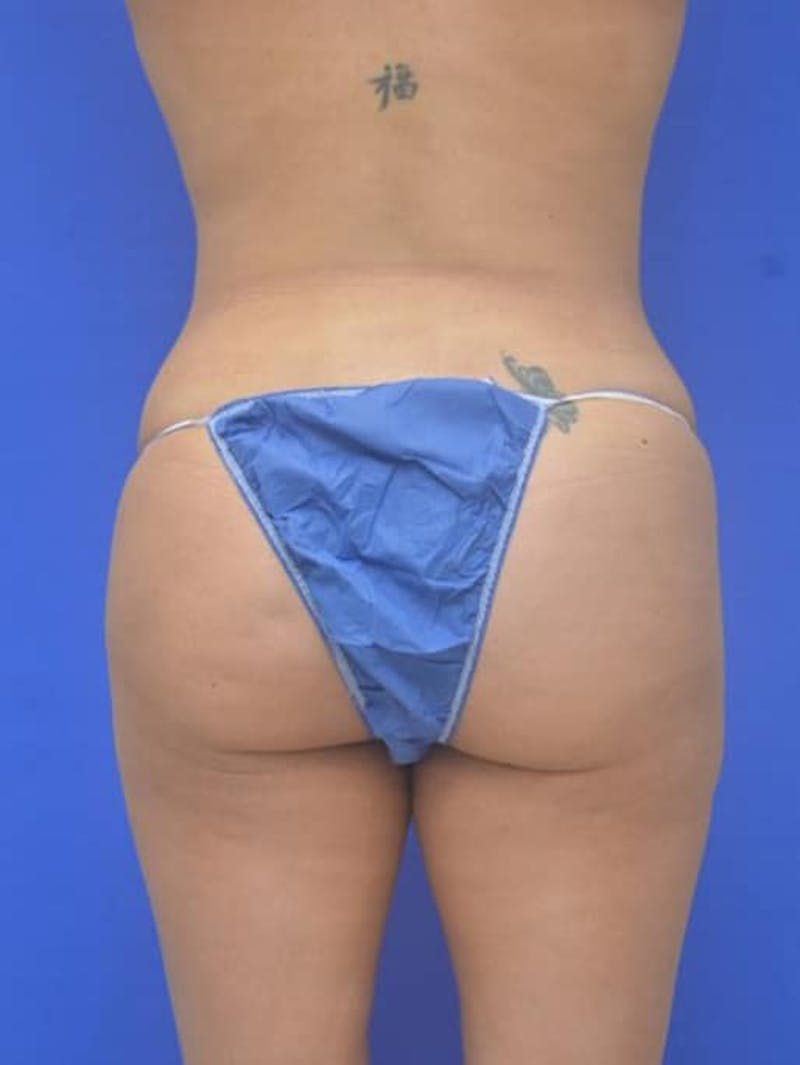 Liposuction Before & After Gallery - Patient 628941 - Image 11