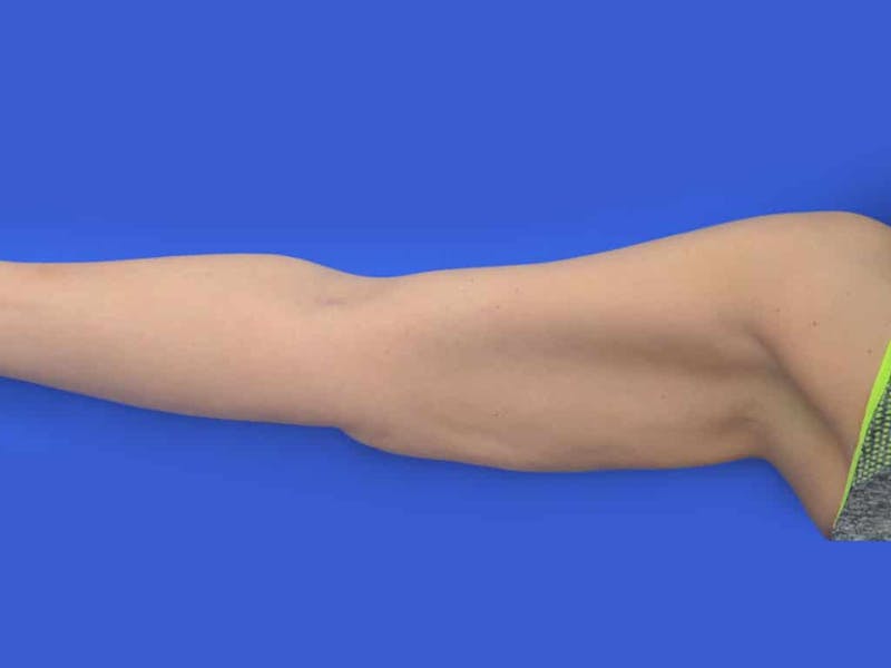 Liposuction Before & After Gallery - Patient 398586 - Image 1