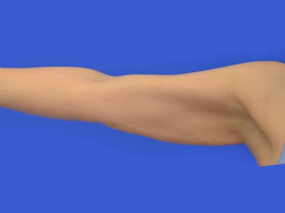 Liposuction Before & After Gallery - Patient 398586 - Image 2
