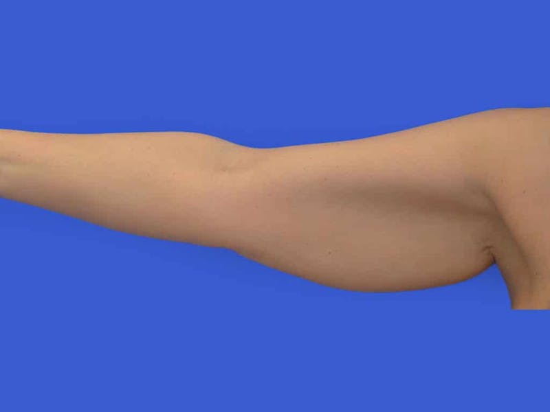 Liposuction Before & After Gallery - Patient 398586 - Image 3