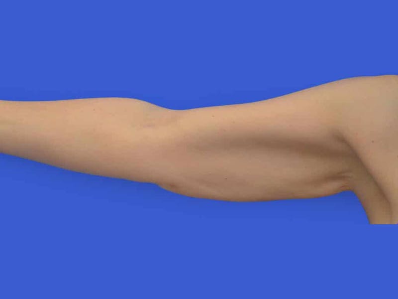 Liposuction Before & After Gallery - Patient 398586 - Image 4