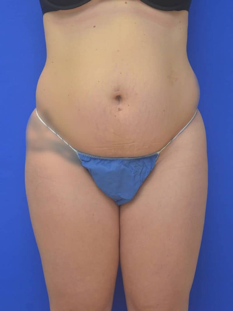 Liposuction Before & After Gallery - Patient 127665 - Image 1