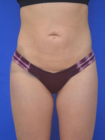 Liposuction Before & After Gallery - Patient 127665 - Image 2