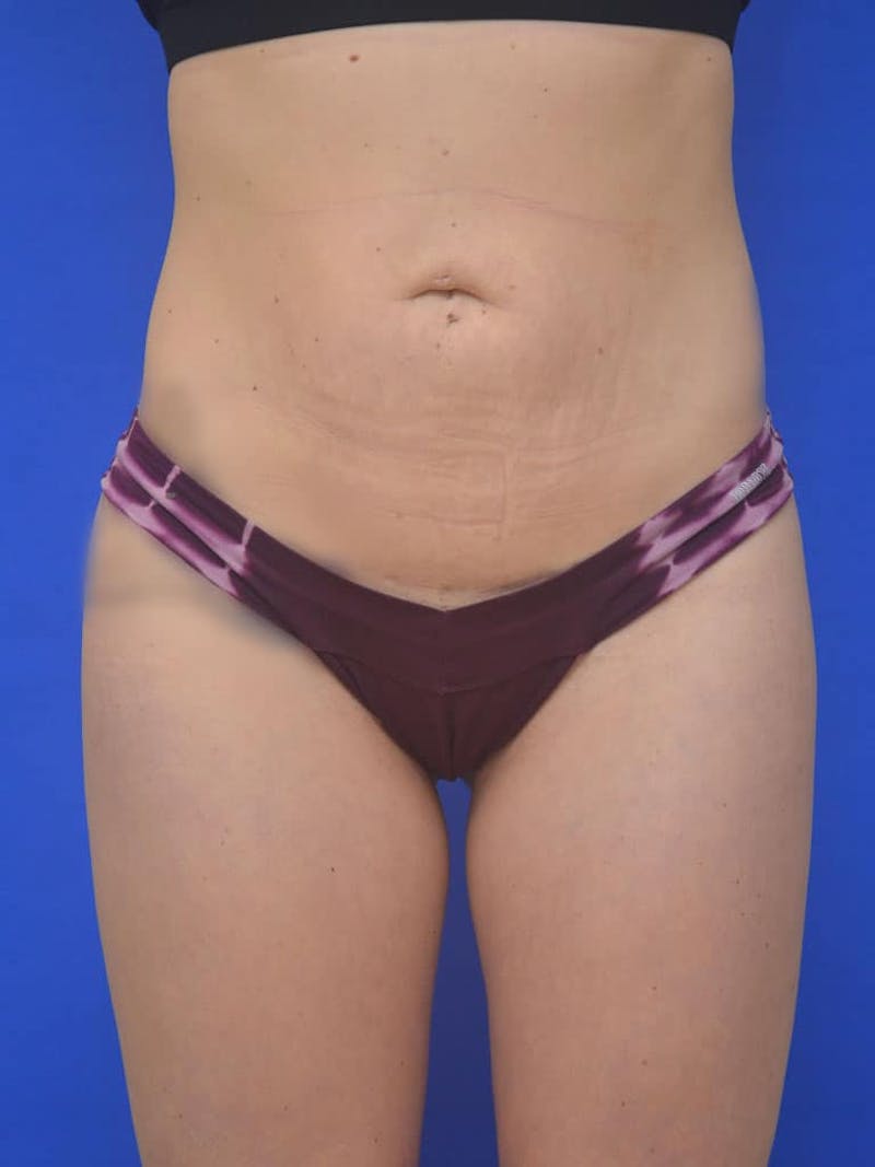 Liposuction Before & After Gallery - Patient 127665 - Image 2