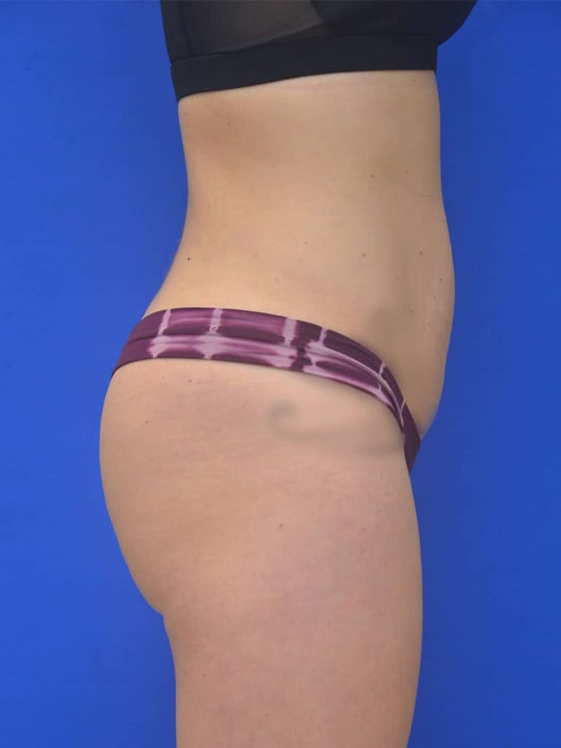 Liposuction Before & After Gallery - Patient 127665 - Image 4