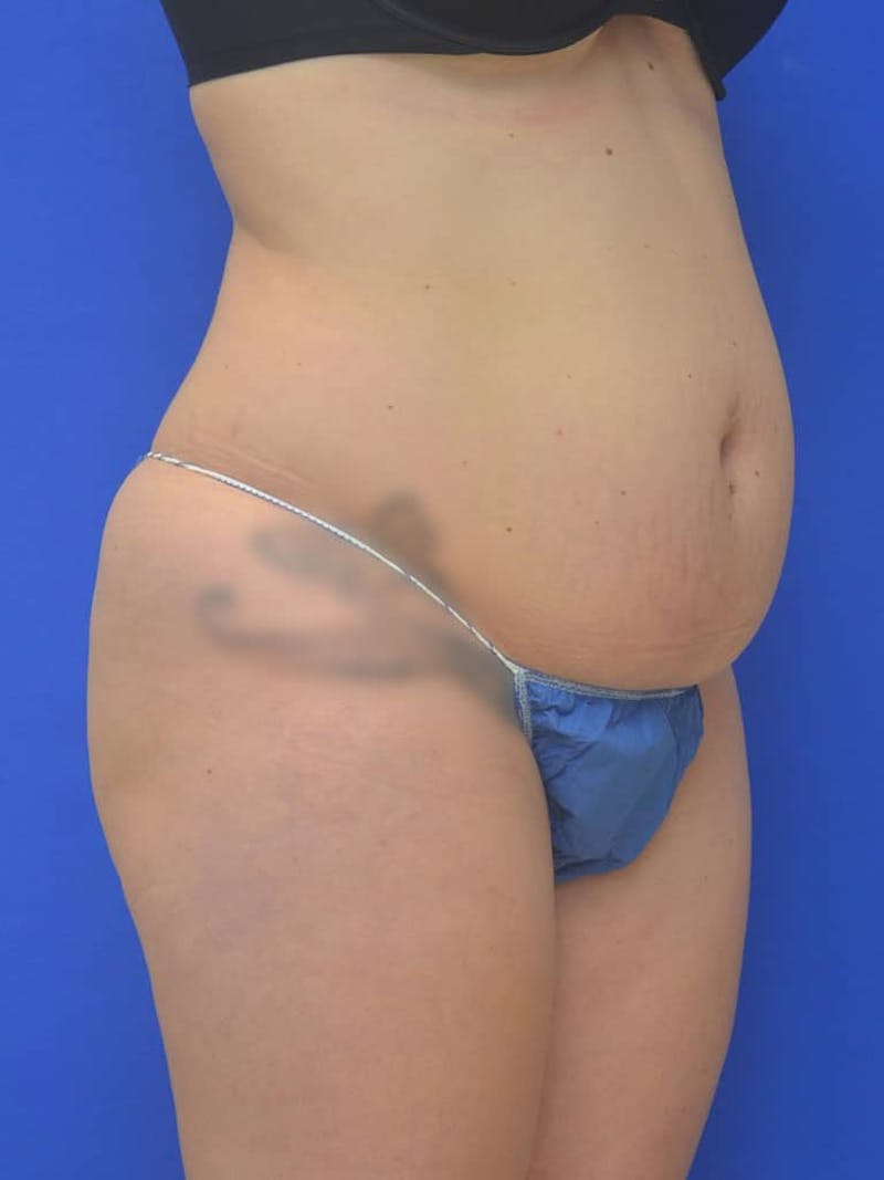 Liposuction Before & After Gallery - Patient 127665 - Image 5