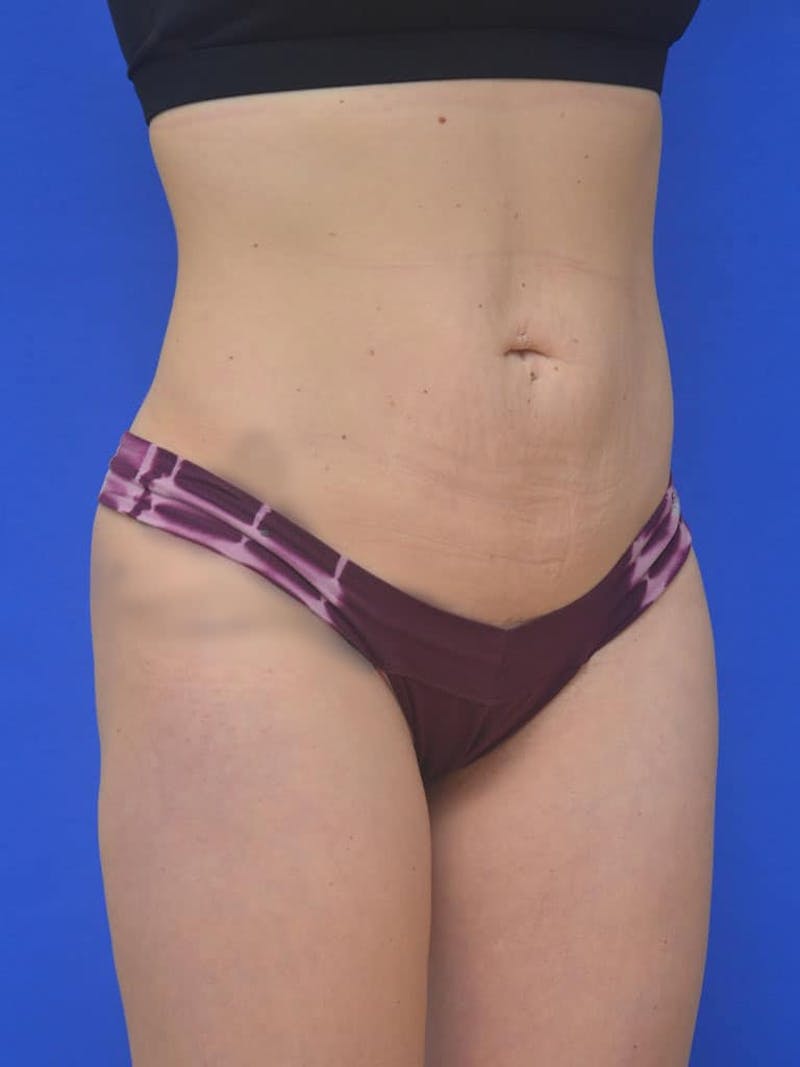 Liposuction Before & After Gallery - Patient 127665 - Image 6