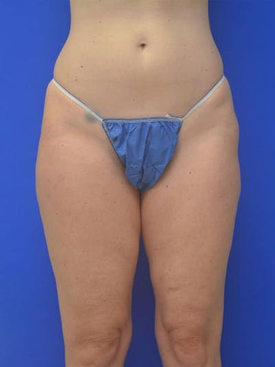 Liposuction Before & After Gallery - Patient 364924 - Image 1