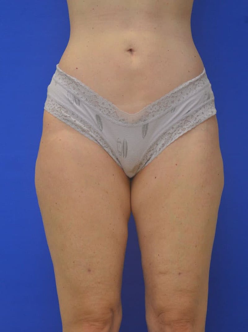 Liposuction Before & After Gallery - Patient 364924 - Image 2