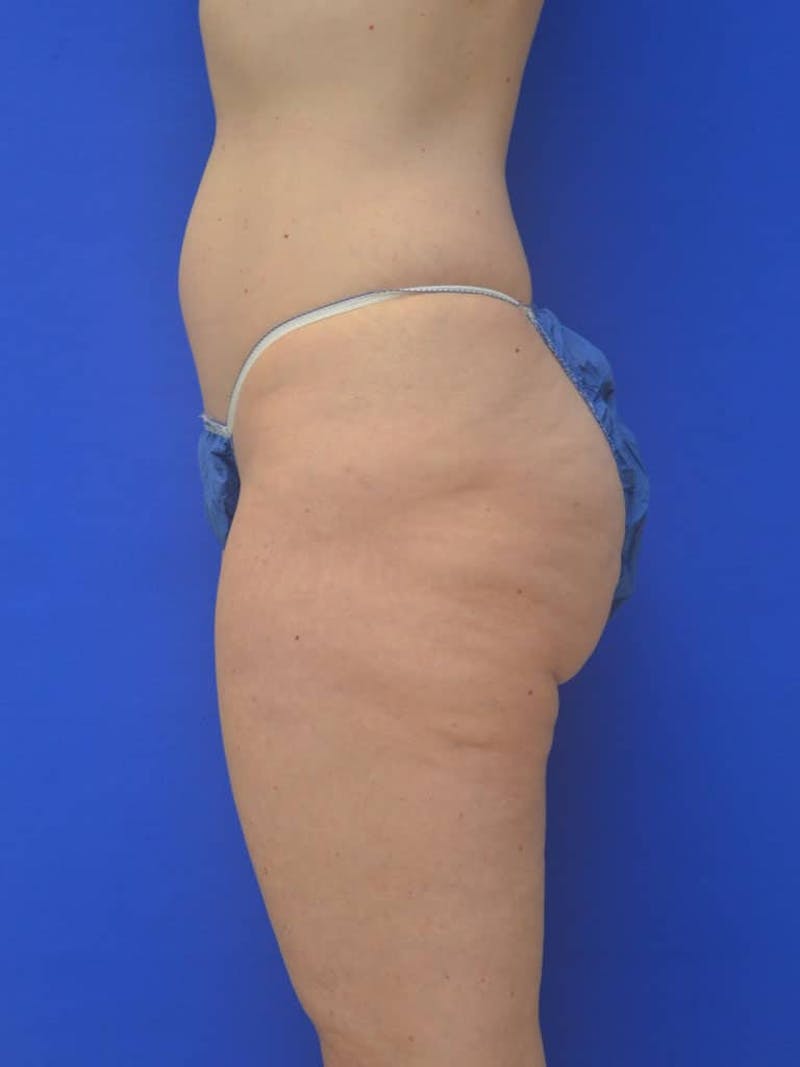 Liposuction Before & After Gallery - Patient 364924 - Image 3