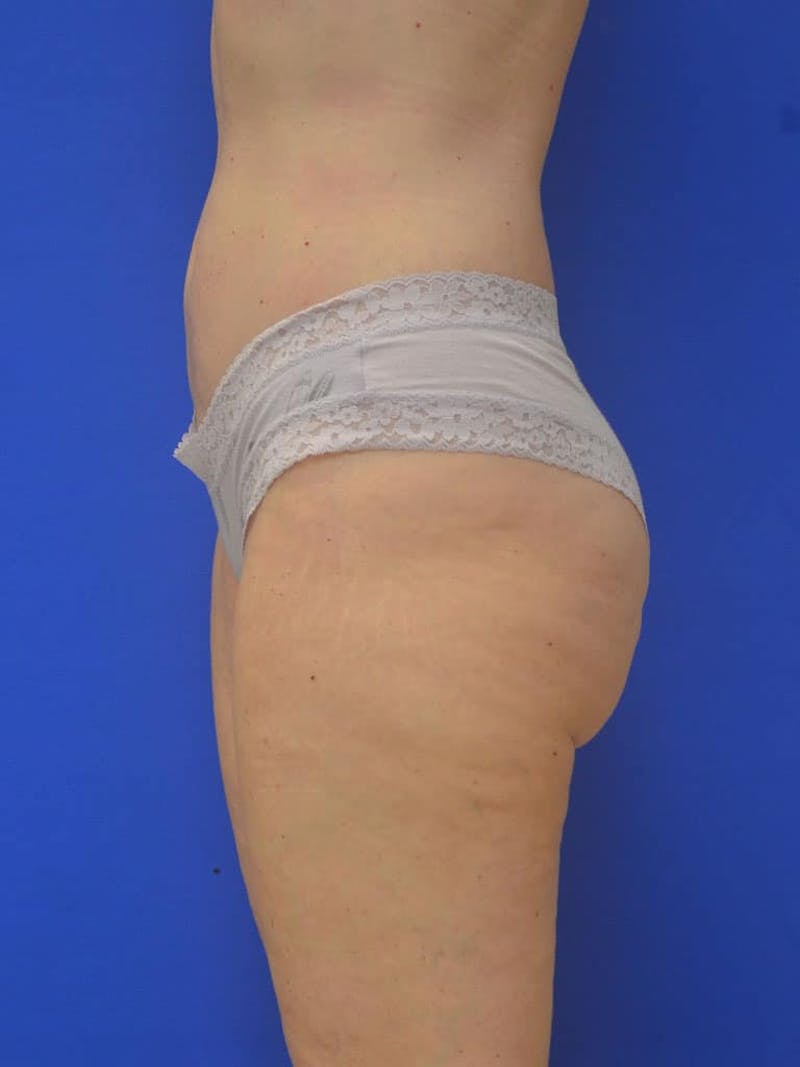 Liposuction Before & After Gallery - Patient 364924 - Image 4