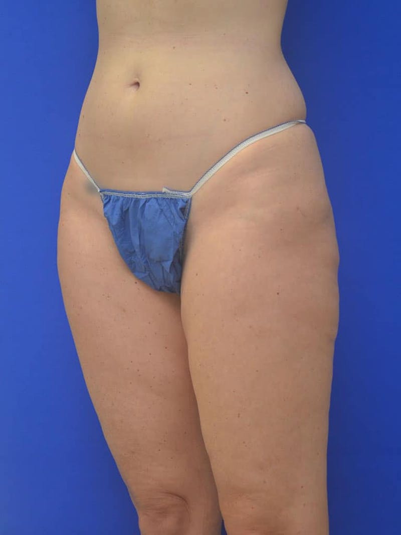 Liposuction Before & After Gallery - Patient 364924 - Image 5