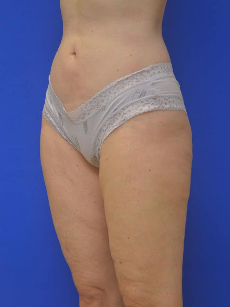 Liposuction Before & After Gallery - Patient 364924 - Image 6