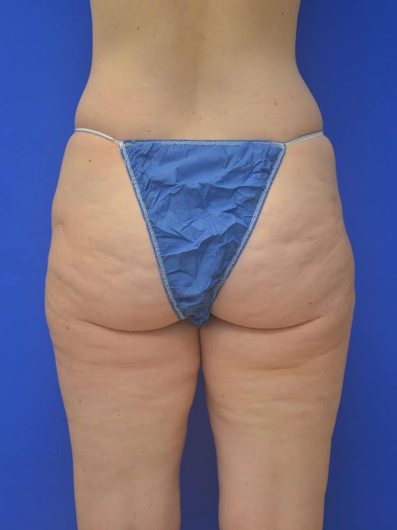 Liposuction Before & After Gallery - Patient 364924 - Image 7
