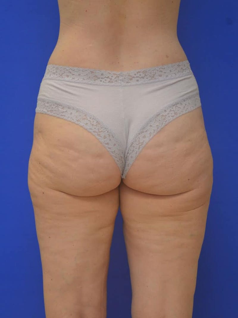 Liposuction Before & After Gallery - Patient 364924 - Image 8