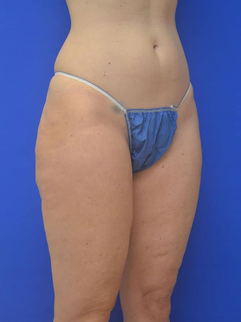 Liposuction Before & After Gallery - Patient 364924 - Image 9