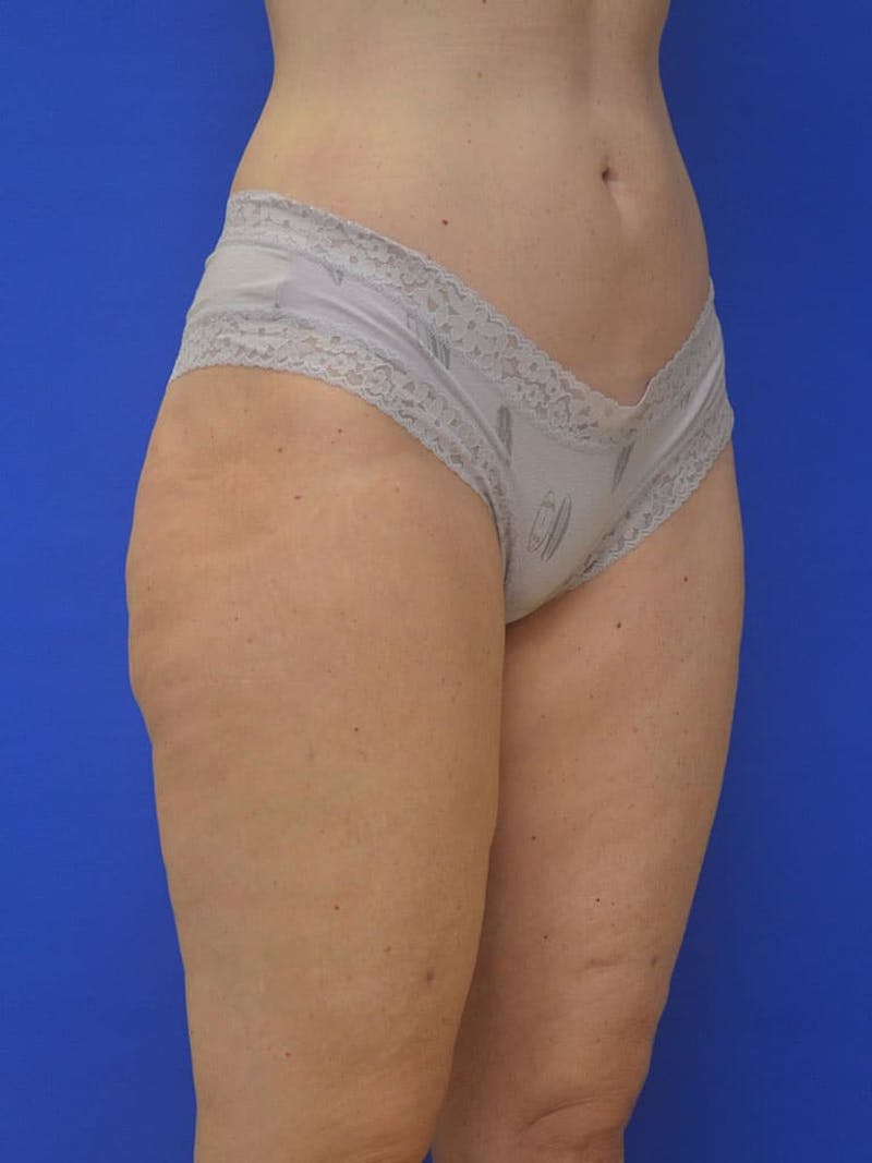 Liposuction Before & After Gallery - Patient 364924 - Image 10