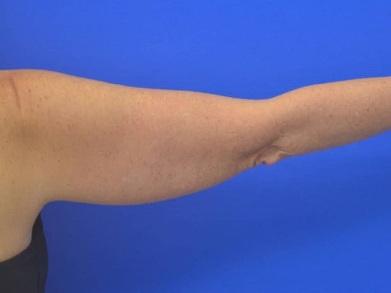 Liposuction Before & After Gallery - Patient 364924 - Image 11