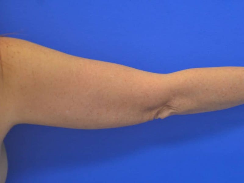 Liposuction Before & After Gallery - Patient 364924 - Image 12
