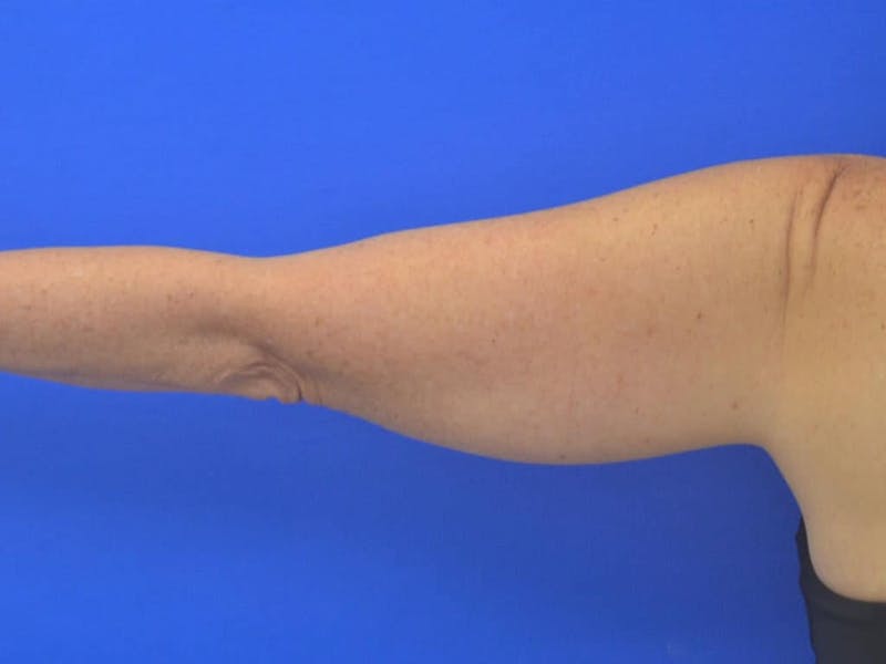 Liposuction Before & After Gallery - Patient 364924 - Image 13