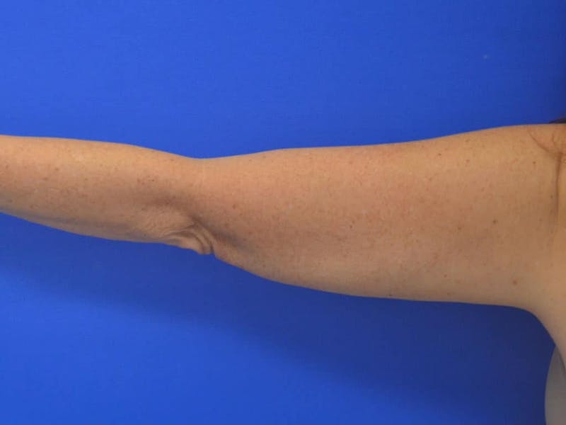 Liposuction Before & After Gallery - Patient 364924 - Image 14