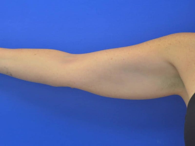 Liposuction Before & After Gallery - Patient 364924 - Image 15