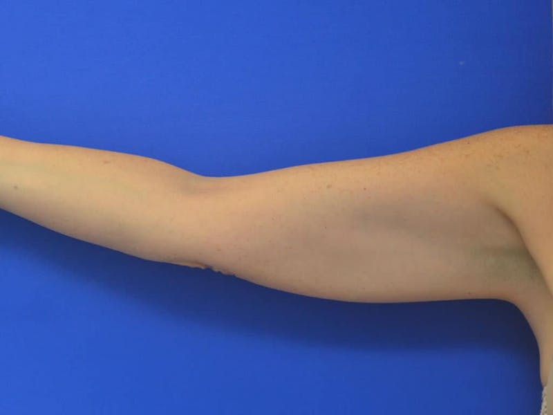 Liposuction Before & After Gallery - Patient 364924 - Image 16