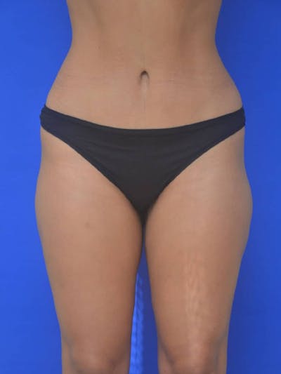 Liposuction Before & After Gallery - Patient 808347 - Image 2