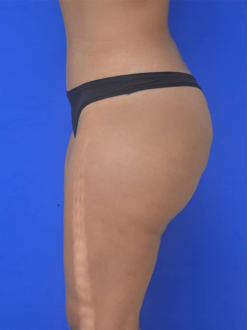 Liposuction Before & After Gallery - Patient 808347 - Image 4