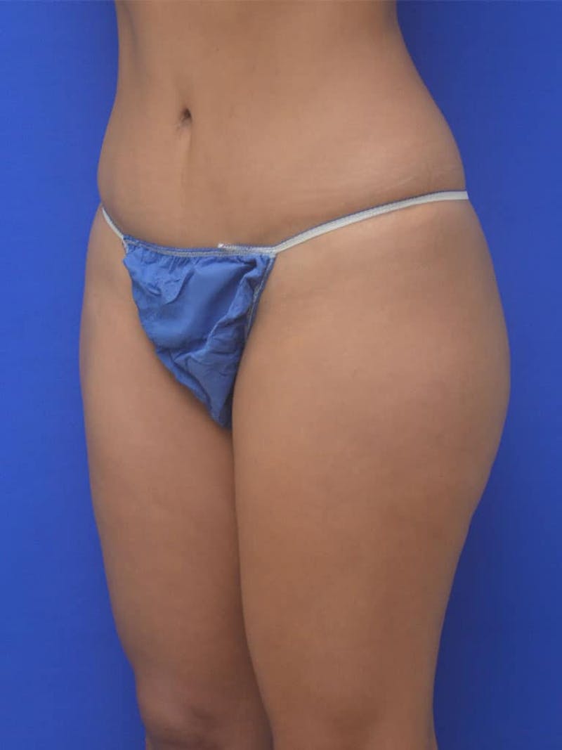 Liposuction Before & After Gallery - Patient 808347 - Image 5