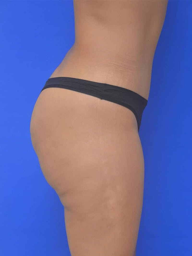 Liposuction Before & After Gallery - Patient 808347 - Image 10