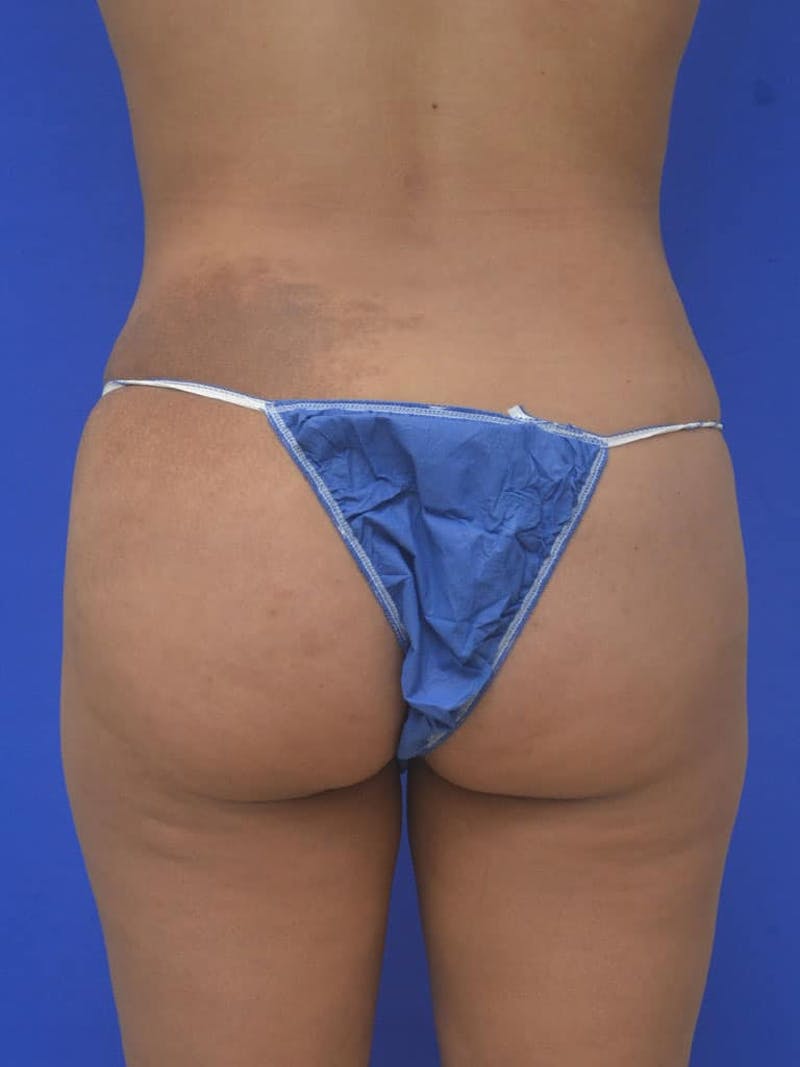 Liposuction Before & After Gallery - Patient 378238 - Image 6