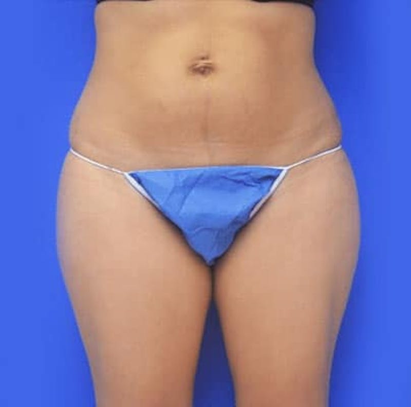 Liposuction Before & After Gallery - Patient 167726 - Image 1