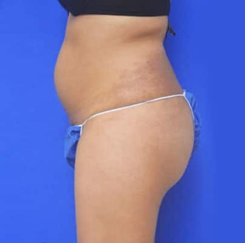 Liposuction Before & After Gallery - Patient 167726 - Image 3