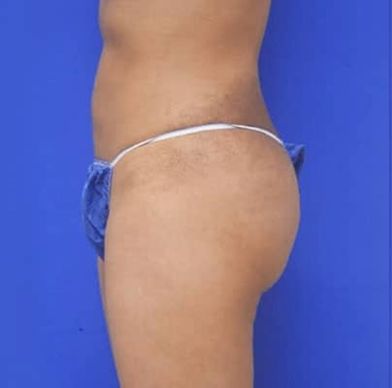 Liposuction Before & After Gallery - Patient 167726 - Image 4