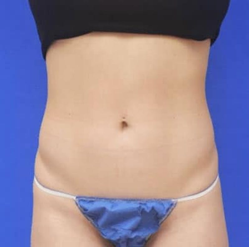 Liposuction Before & After Gallery - Patient 255729 - Image 1