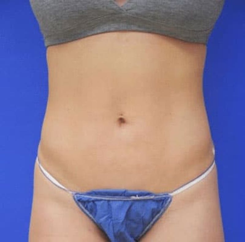 Liposuction Before & After Gallery - Patient 255729 - Image 2