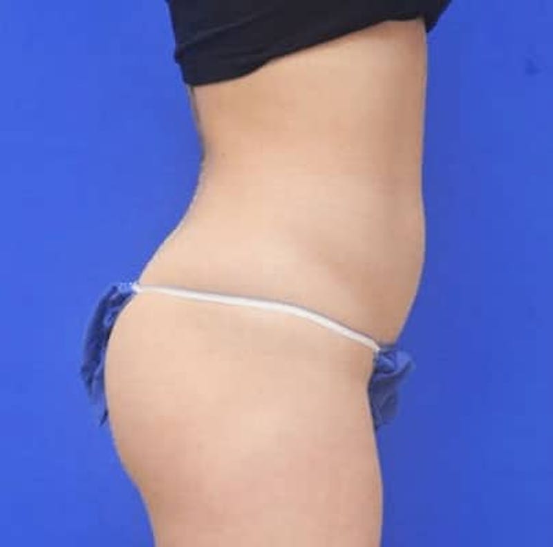 Liposuction Before & After Gallery - Patient 255729 - Image 5