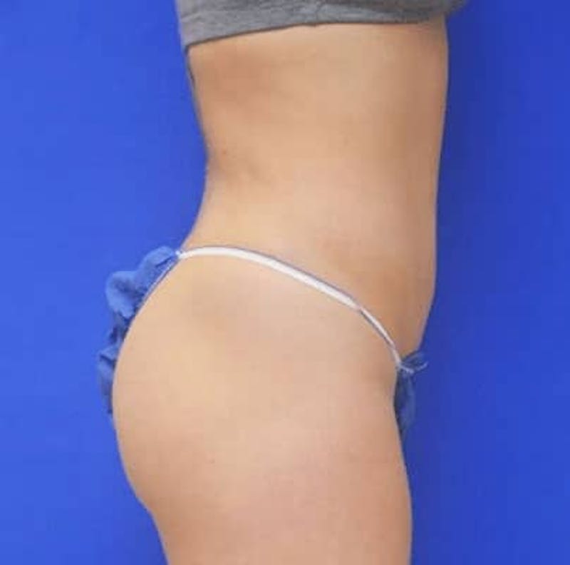 Liposuction Before & After Gallery - Patient 255729 - Image 6